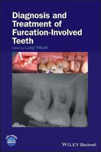 Diagnosis and Treatment of Furcation-Involved Teeth