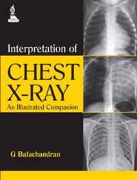 Interpretation of Chest X-Ray