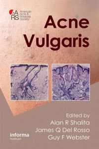 Acne Vulgaris