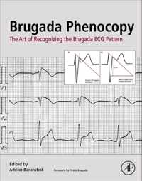 Brugada Phenocopy