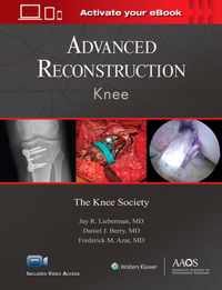 Advanced Reconstruction: Knee