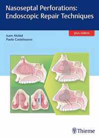 Nasoseptal Perforations