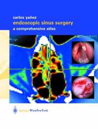 Endoscopic Sinus Surgery