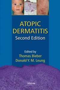 Atopic Dermatitis