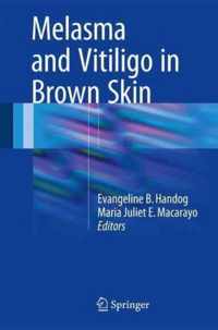 Melasma and Vitiligo in Brown Skin