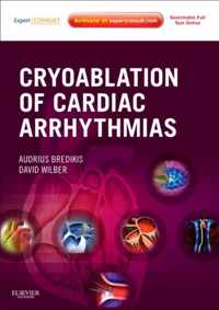 Cryoablation of Cardiac Arrhythmias