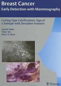 Casting Type Calcifications