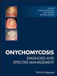 Onychomycosis