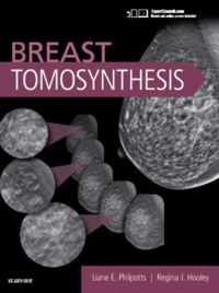 Breast Tomosynthesis