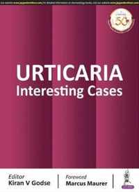 Urticaria