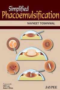 Simplified Phacoemulsification