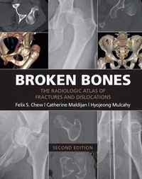 Broken Bones