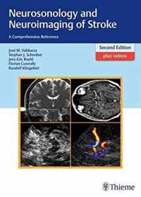 Neurosonology and Neuroimaging of Stroke