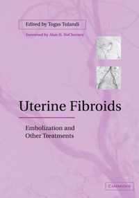 Uterine Fibroids