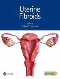 Uterine Fibroids