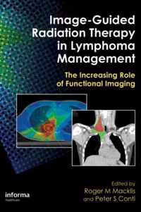 Image-Guided Radiation Therapy in Lymphoma Management