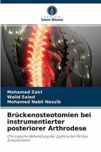 Bruckenosteotomien bei instrumentierter posteriorer Arthrodese