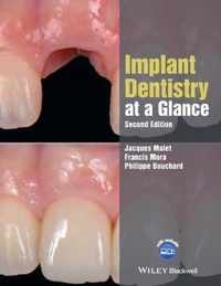 Implant Dentistry at a Glance