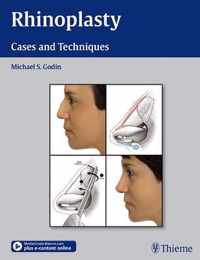 Rhinoplasty - Cases and Techniques