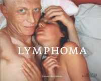 Lymphoma