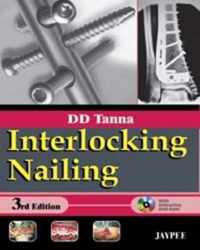 Interlocking Nailing