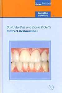 Indirect Restorations