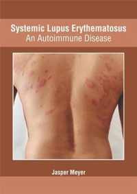 Systemic Lupus Erythematosus