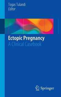 Ectopic Pregnancy