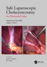 Safe Laparoscopic Cholecystectomy