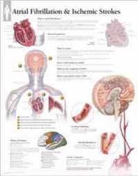 Atrial Fib & Ischemic Strokes Laminated Poster