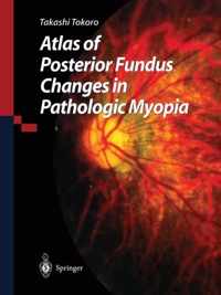 Atlas of Posterior Fundus Changes in Pathologic Myopia