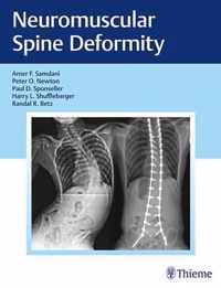 Neuromuscular Spine Deformity