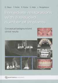 Immediate Restorations With A Reduced Number Of Implants