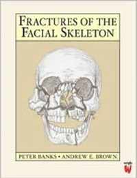 Fractures of the Facial Skeleton