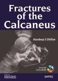 Fractures of the Calcaneus