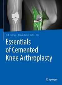 Essentials of Cemented Knee Arthroplasty