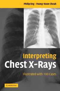 Interpreting Chest X-Rays