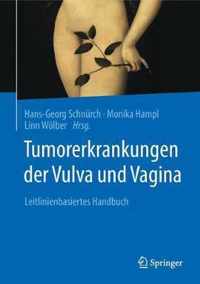 Tumorerkrankungen der Vulva und Vagina