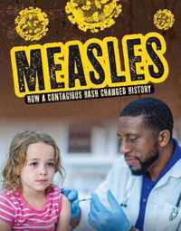 Measles