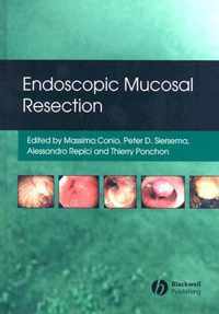 Endoscopic Mucosal Resection