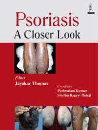 Psoriasis