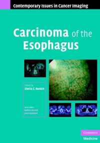 Carcinoma of the Esophagus