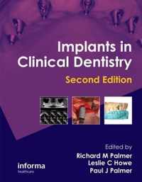 Implants in Clinical Dentistry