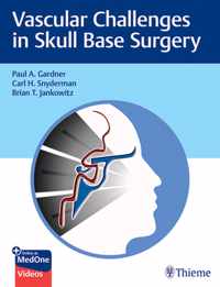 Vascular Challenges in Skull Base Surgery