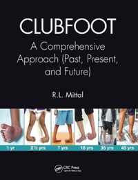 Clubfoot