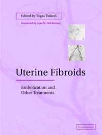 Uterine Fibroids