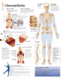 Osteoarthritis Paper Poster