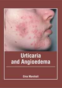 Urticaria and Angioedema