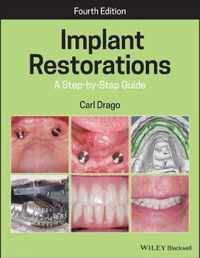 Implant Restorations